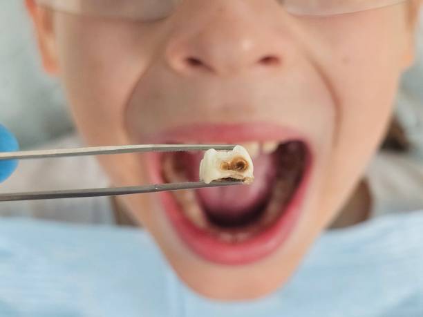 Best Emergency Dental Care for Broken or Chipped Teeth in Paw Paw Lake, MI